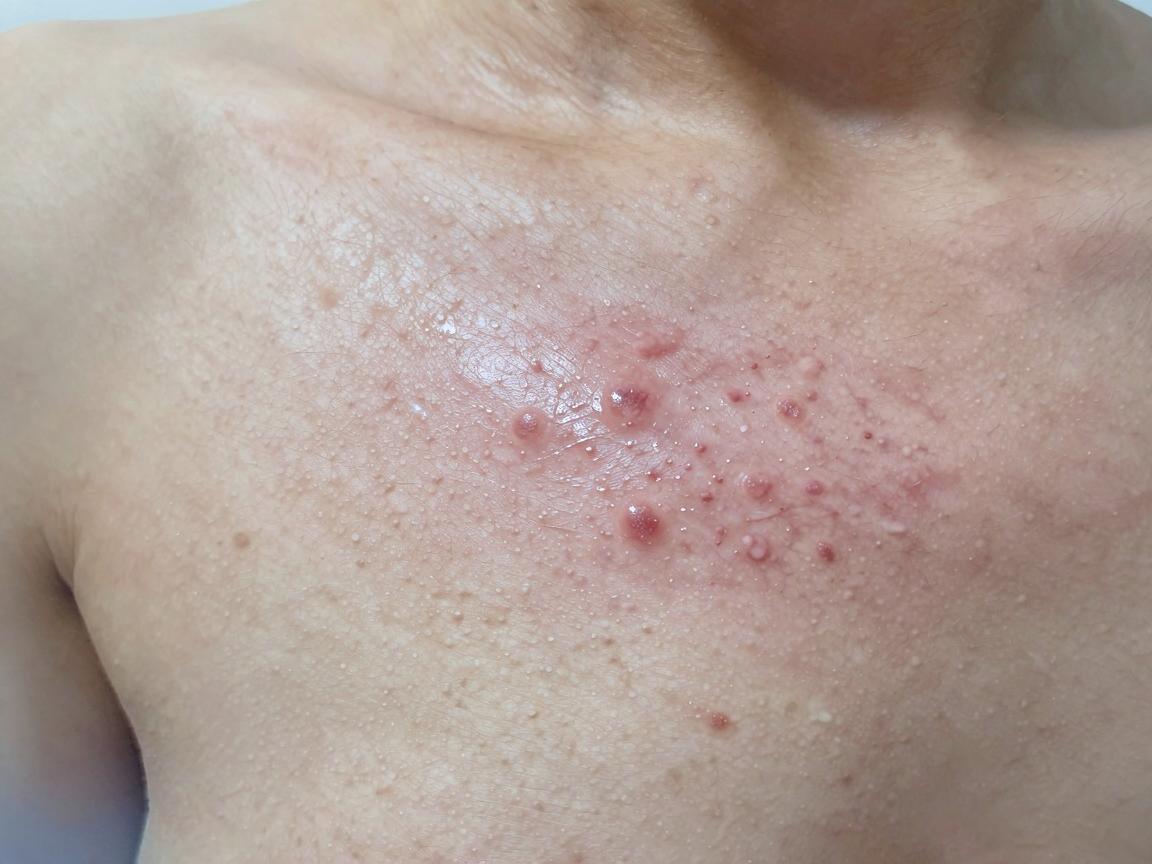 在合肥,针对腋臭(狐臭)的治疗,建议优先选择三甲医院的整形美容科、皮肤科或腋臭专科门诊。这类医院设备先进、医生经验丰富,且能提供微创手术、激光治疗等主流方案 在合肥,针对腋臭(狐臭)的治疗,建议优先选择三甲医院的整形美容科、皮肤科或腋臭专科门诊。这类医院设备先进、医生经验丰富,且能提供微创手术、激光治疗等主流方案