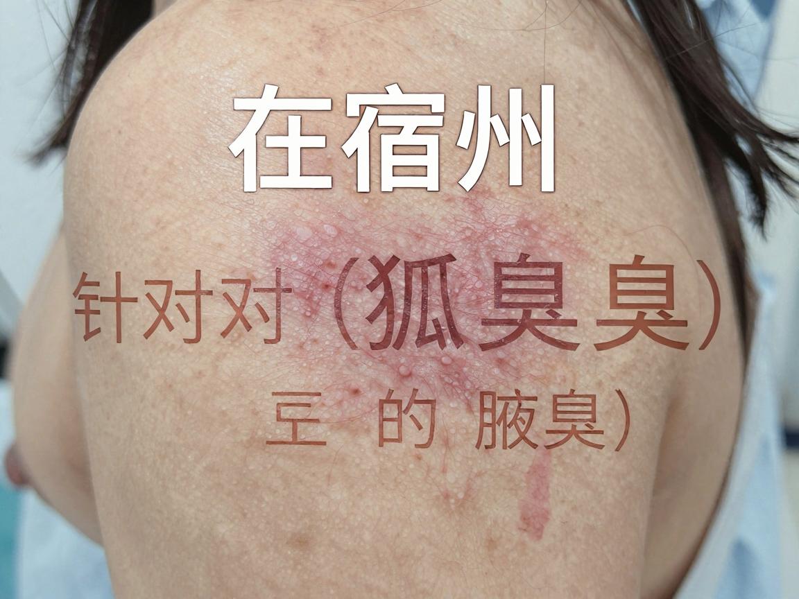 在宿州,针对狐臭(腋臭)的治疗,公立医院的皮肤科或普外科(或整形外科)通常会比较权威。以下是当地口碑较好、相关技术较为成熟的几家医院供你参考 在宿州,针对狐臭(腋臭)的治疗,公立医院的皮肤科或普外科(或整形外科)通常会比较权威。以下是当地口碑较好、相关技术较为成熟的几家医院供你参考